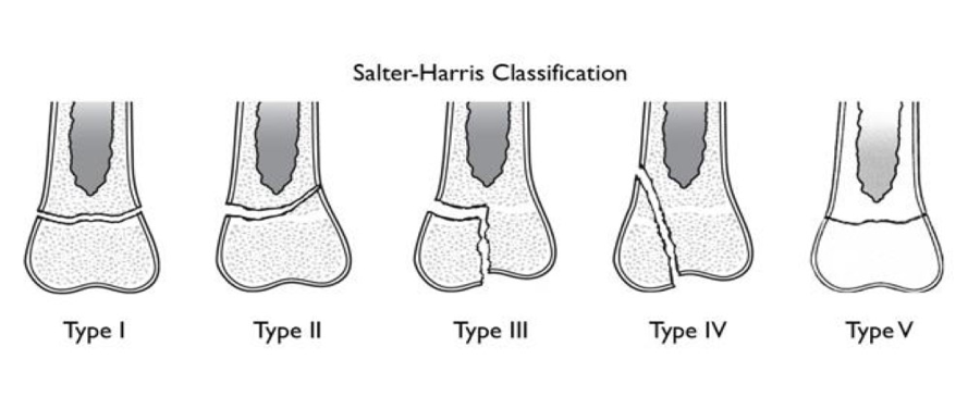 Salter-Harris Classification